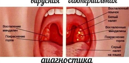 Можно Ли Делать Куни При Ангине