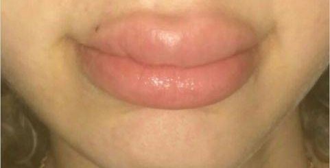 После Куни Отекли Губы
